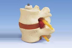 3 Lumbar Vertebrae With Prolapsed Disc Flexible Mount